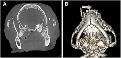 Management of bilateral pterygoid myositis ossificans-like lesion in dogs